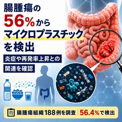 腸腫瘍からマイクロプラスチック